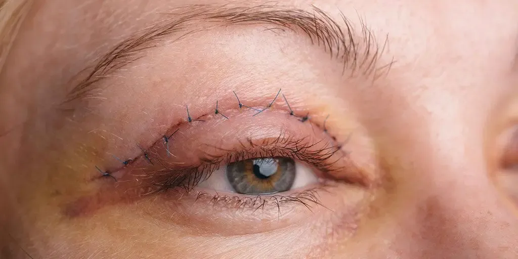 Cirugía de Párpados