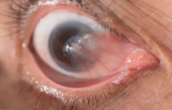 Cirugía de Pterigión